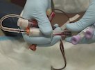 First human blood transfusion (1667)
